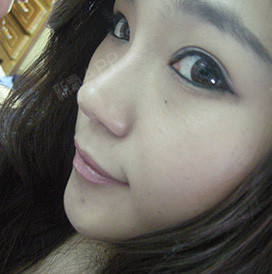 怀柔姐姐膨体隆鼻第31天美丽日记-新氧美容整形