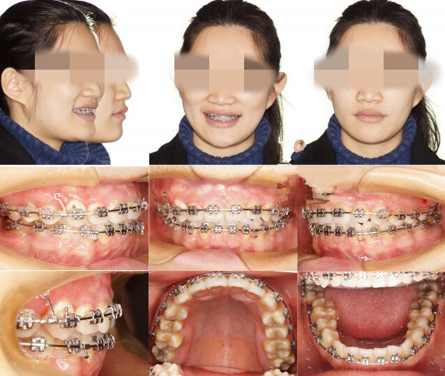 患者侧面凸出,前牙轴倾度也偏大,有牙齿缺失,咬合关系