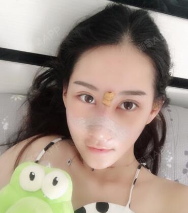 红衣女孩鼻综合第5天美丽日记-新氧美容整形