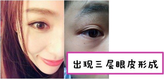 双眼皮宽度ok了,但是出现三层眼皮.
