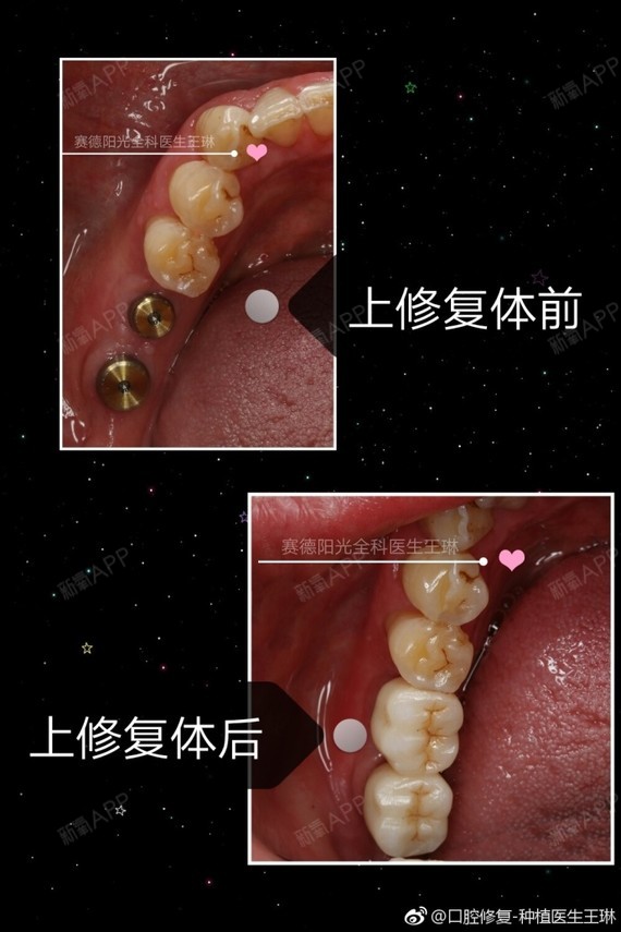 王琳医生科普案例