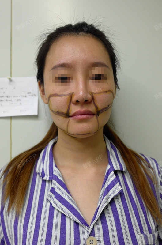 赵三金面部吸脂第0天美丽日记-新氧美容整形