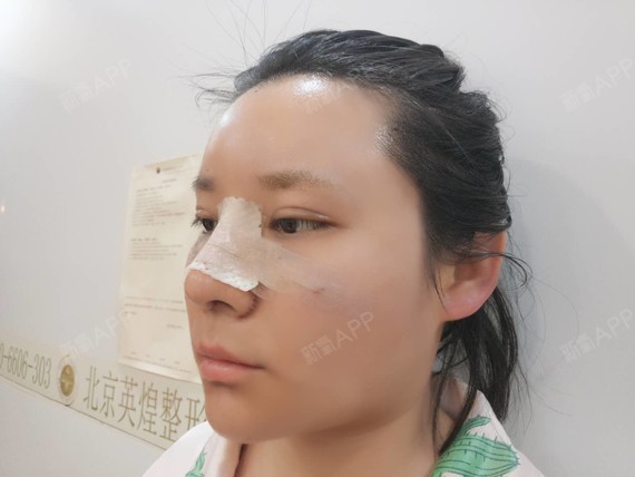 小阿黑黑ge鼻部修复第2天美丽日记-新氧美容整