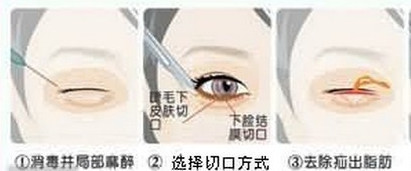 做完祛眼袋手术后，卧蚕会消失么?相信大家现在对于卧蚕和眼袋的区别已经能非_圈子-新氧美容整形