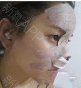 默默的我默默鼻综合第0天美丽日记-新氧美容整