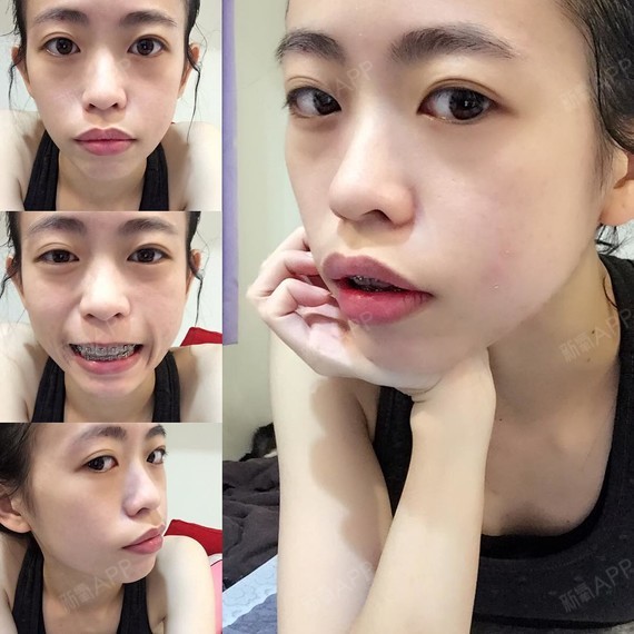 上下唇内收,嘴突改善,侧貌线条流畅.