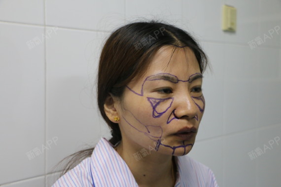 感觉自己好滑稽术前手术的时候,王院长给我在脸上的画线,需要填充