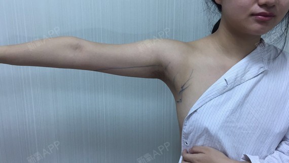 新氧 思思杰杰 胸部 美体塑形 去副乳 吸脂去副乳 吸脂瘦