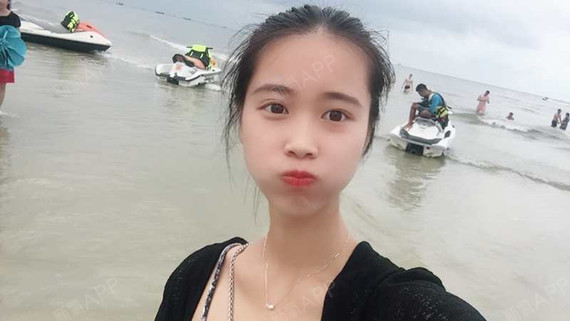 我要变美征服你自体脂肪全脸填充第38天美丽