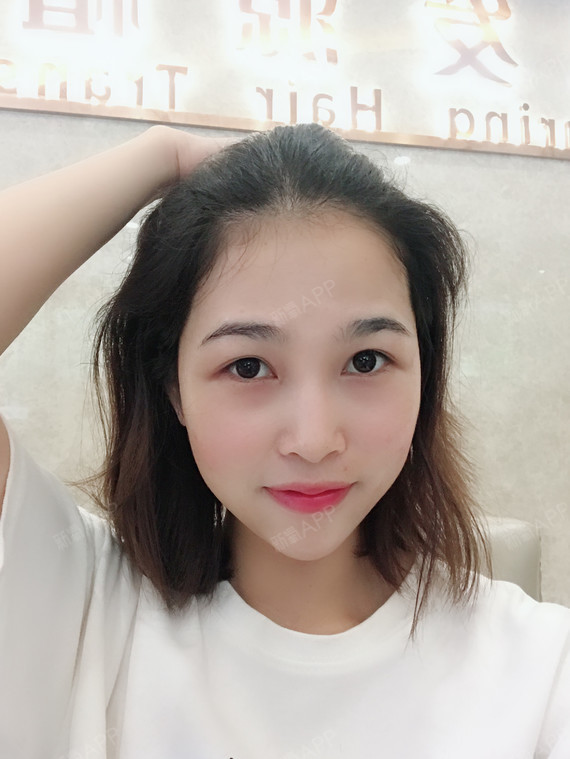 哈喽c辣辣种植发际线第0天美丽日记-新氧美容