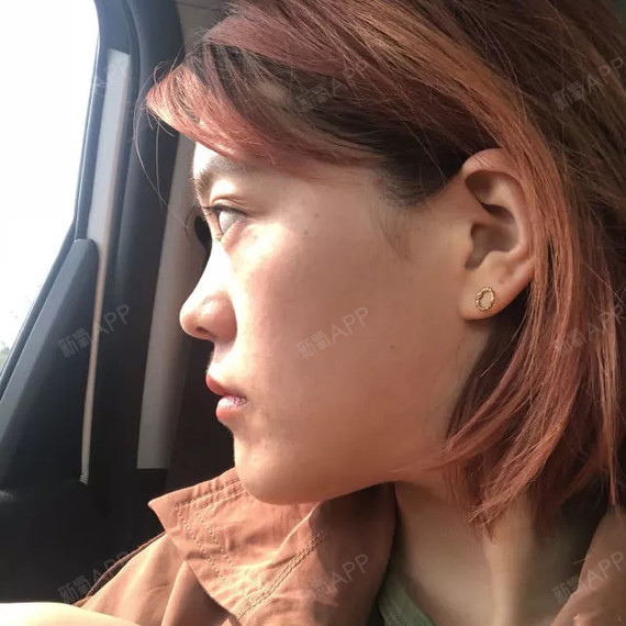我虽然咬合关系十分差,但是我牙齿很整齐,面部只有一点轻微兜齿,脸也