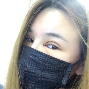 宁宁姐姐开内眼角第108天美丽日记-新氧美容整