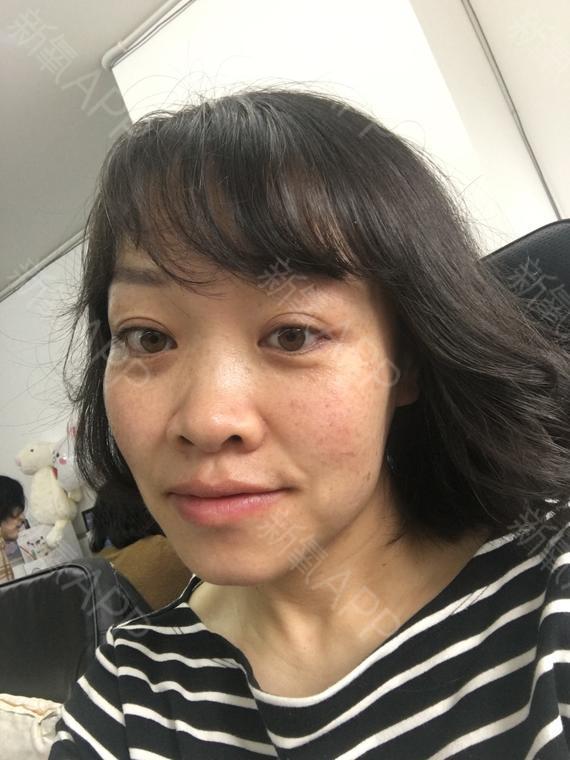 皮秒激光第7天