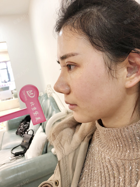 我惹的事鼻综合第6天美丽日记-新氧美容整形