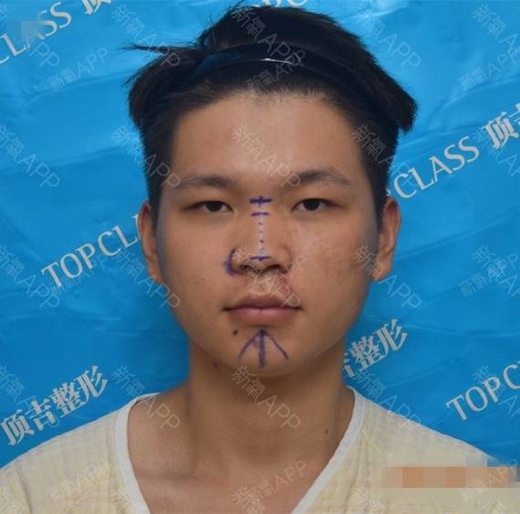 啾啾小王子鼻综合第605天美丽日记-新氧美容整