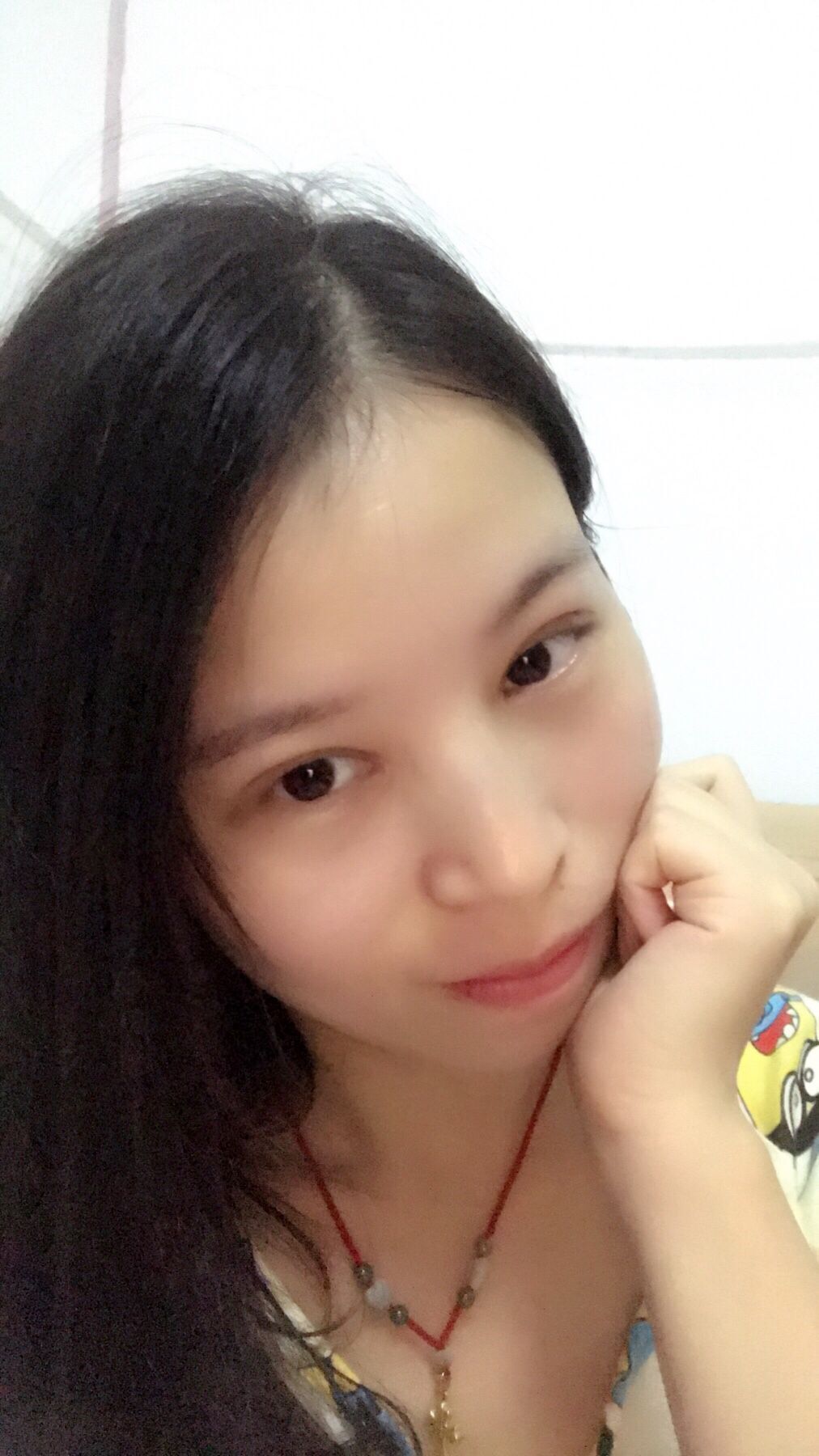 切开双眼皮第30天