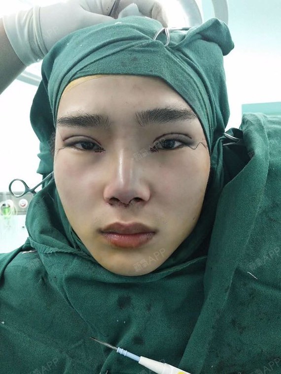 凡事都要勇于尝试开内眼角第0天美丽日记-新氧