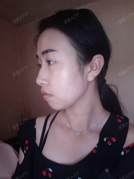 透明水瓶子切开双眼皮第0天美丽日记-新氧美容