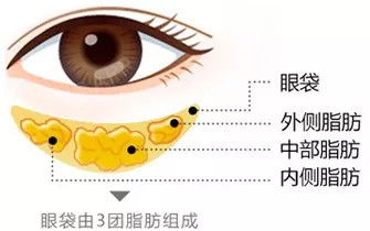 眼袋出现伴随的其他眼部问题 脂肪膨出 眼袋是由眶隔筋膜的内,中,外