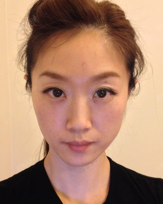 过了大约三周后我才真正感觉到效果,最明显的改变是咀嚼肌