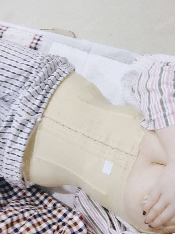 我要得变美美哒吸脂瘦小腿第2天美丽日记-新氧