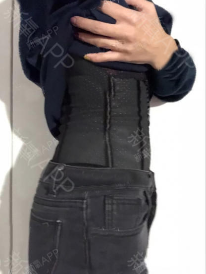 肖君庙吸脂瘦腰部第32天美丽日记-新氧美容整