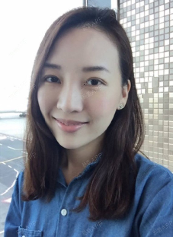 不得不走a切开双眼皮第20天美丽日记-新氧美容