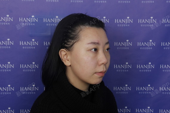 氧气4749321521398865皮秒激光第0天美丽日