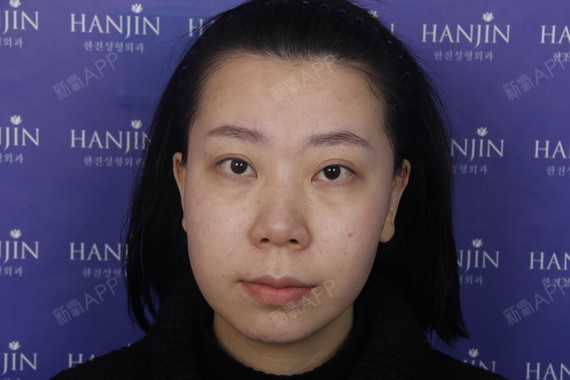 氧气4749321521398865皮秒激光第0天美丽日