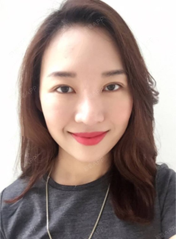 不得不走a切开双眼皮第20天美丽日记-新氧美容