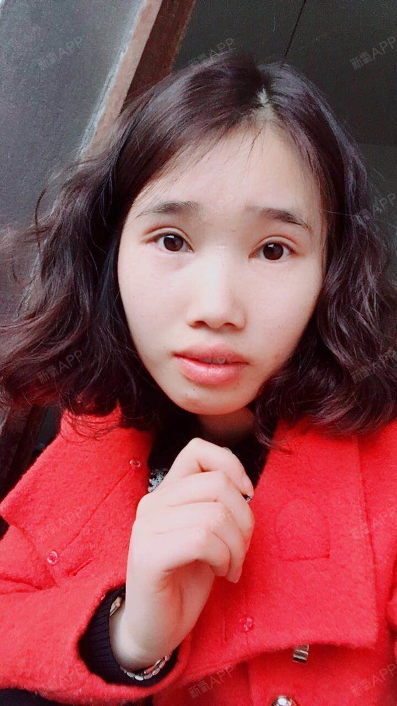 自从做了双眼皮手术,祛疤膏我只有想到才会涂一下,但_圈子-新氧美容