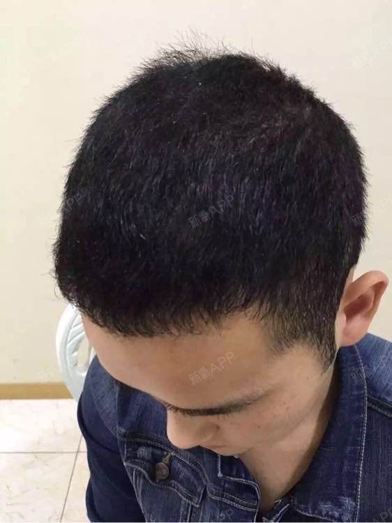 衣tt头顶加密种植第74天美丽日记-新氧美容整形