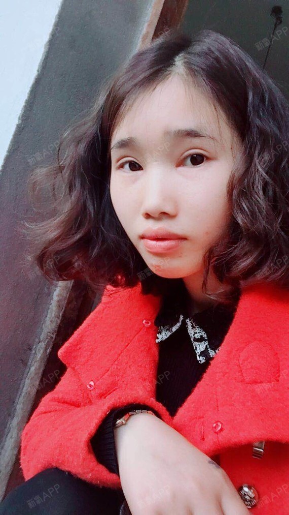 自从做了双眼皮手术,祛疤膏我只有想到才会涂一下,但_圈子-新氧美容