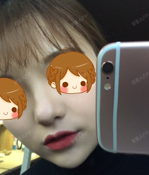 氧气7565511505997841激光点痣第35天美丽