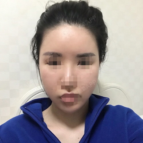 氧-莱茵贝缇韩国不让米汤|瘦脸轮廓|医院|面整形喝面部为什么吃减肥药图片