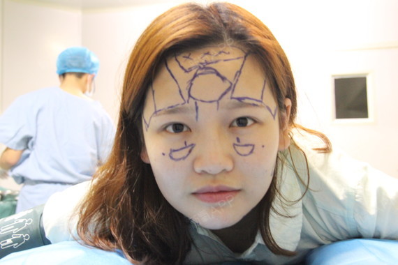 自体脂肪填脸,留住少女感!我们的25岁胶原蛋白