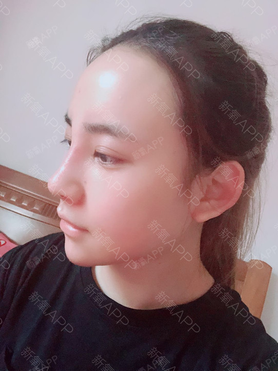 萍果_鼻部修复第7天美丽日记-新氧美容整形