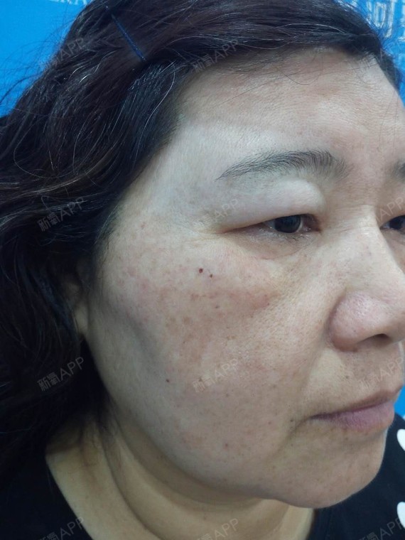 汪汪汪汪汪汪汪汪激光祛斑第458天美丽日记-新