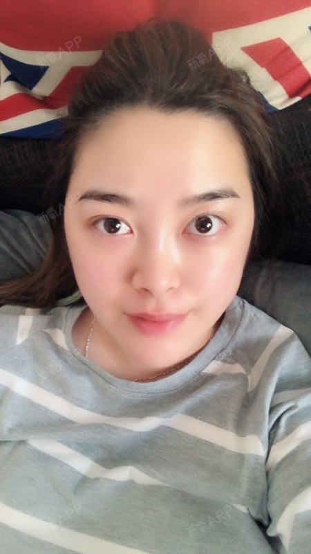 吉宝肉毒素瘦脸第1天美丽日记-新氧美容整形