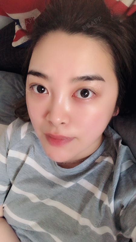 吉宝肉毒素瘦脸第1天美丽日记-新氧美容整形