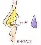 肋软骨隆鼻