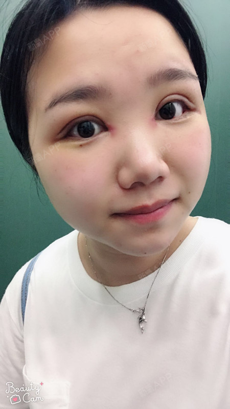 阿尔法的猫切开双眼皮第7天美丽日记-新氧美容