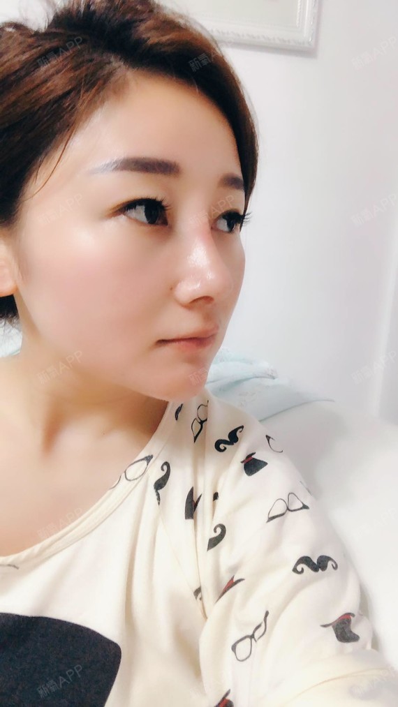孟甜甜硅胶隆鼻第26天美丽日记