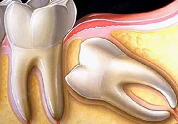 什么样的智齿可以不拔?