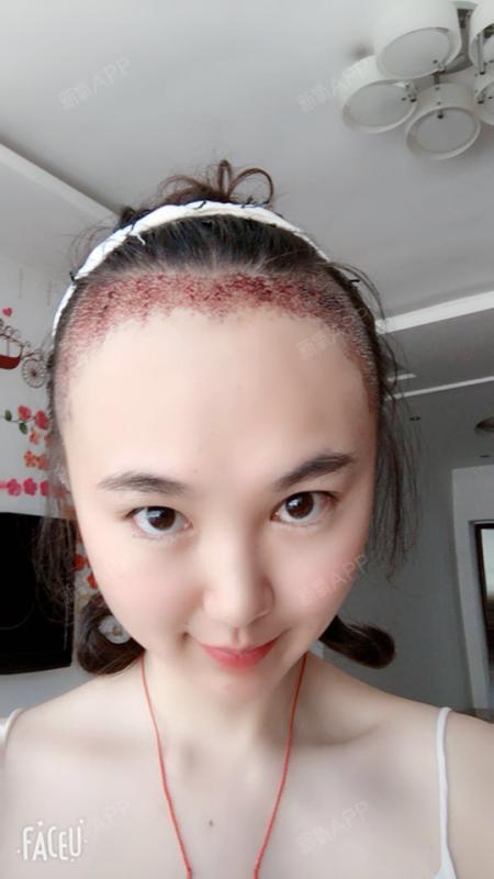种植发际线