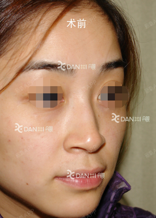 【鼻整形案例:鼻中隔偏曲矫正,去驼峰,膨体隆鼻,鼻