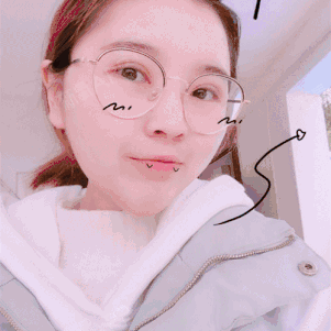 持续消肿期切开双眼皮第15天 · 第1篇日记