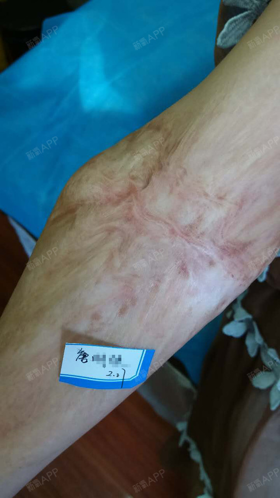 长沙手术祛疤好不好_效果图_氧气joo3154手术祛疤术后第69天_新氧美容