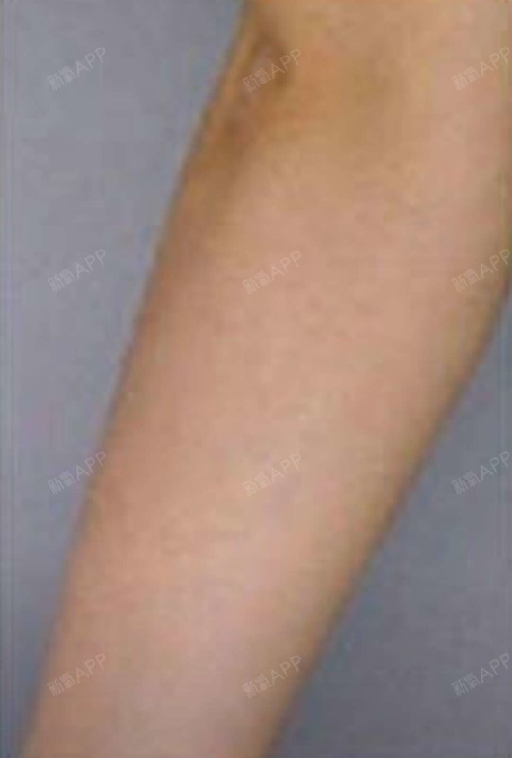 小册子子脱腋毛第206天美丽日记-新氧美容整形
