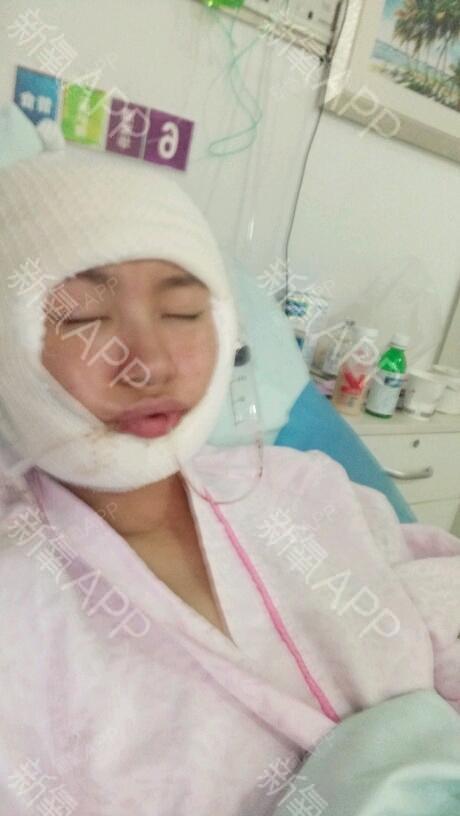 氧气5793901528280616V-LINE瓜子脸手术第